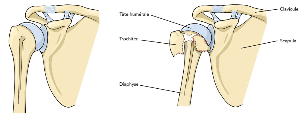 Fracture humérus