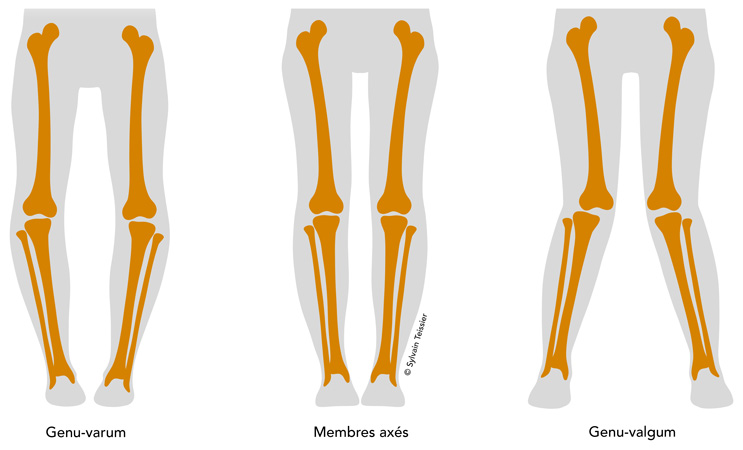 L'arthrose unicompartimentale du genou - Orthèses Biomec