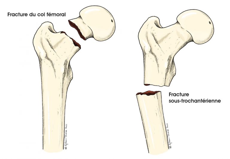 Les fractures du fémur proximal Institut de Chirurgie Réparatrice