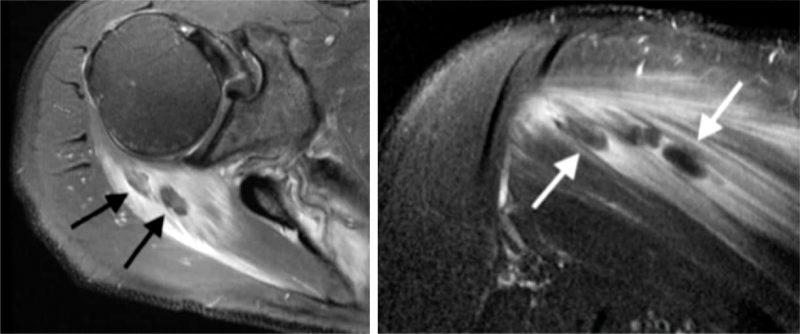 Echographie calcifications